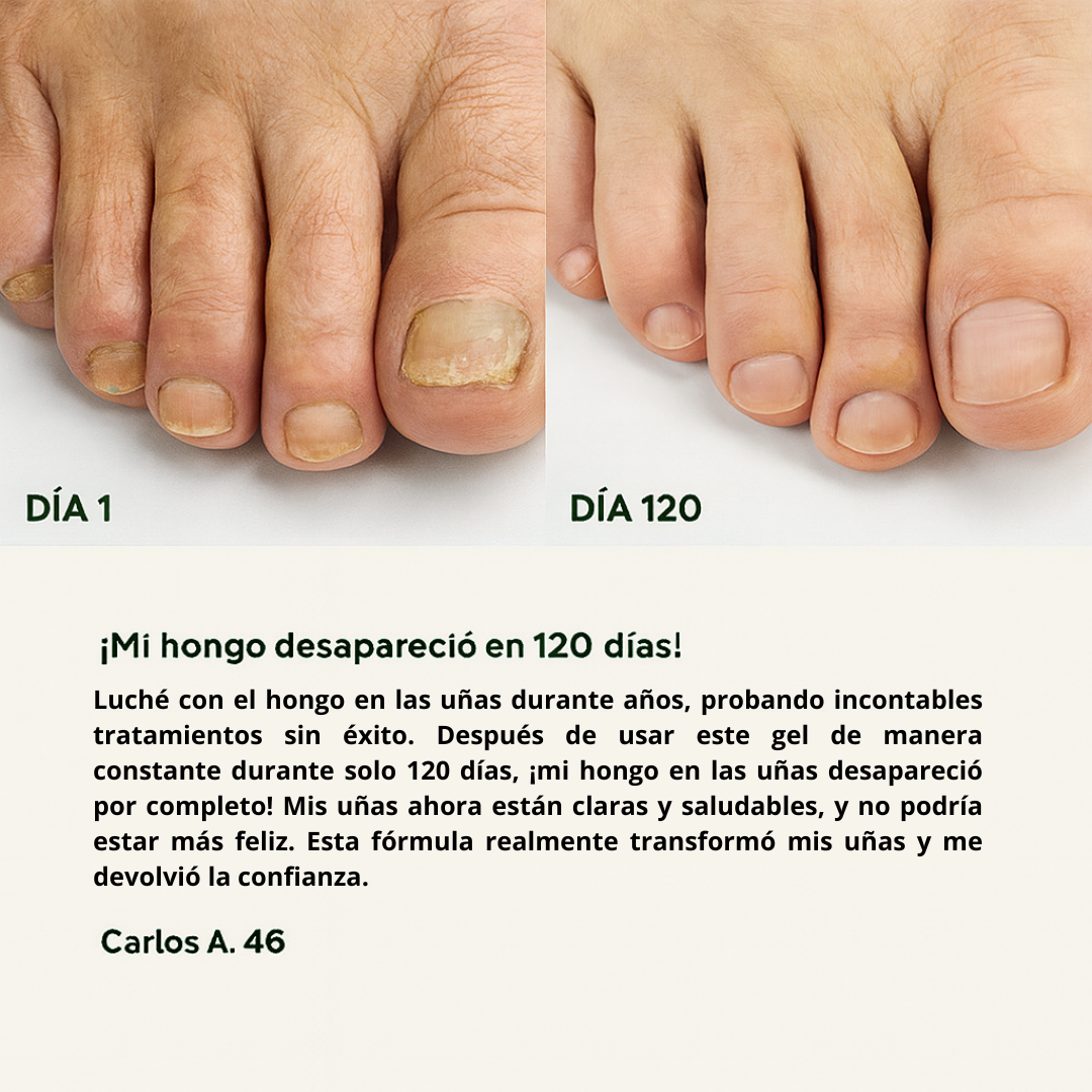 ByeFungus™ – Dile adiós a los hongos y disfruta de unas uñas sanas.